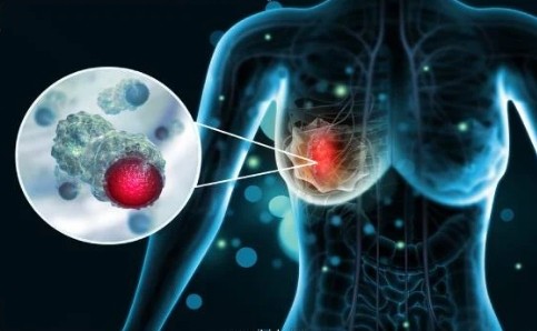 banner Traitement de cancer du sein